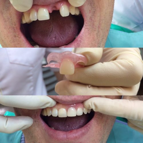 Протезирование зубов