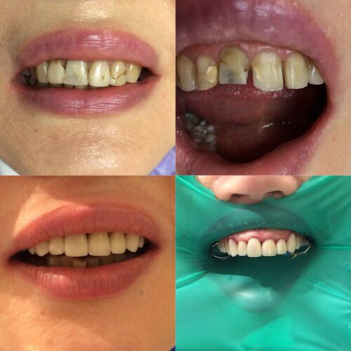 Имплантация зубов