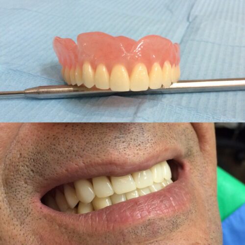 протезирование1