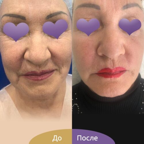 Пластика лица и шеи