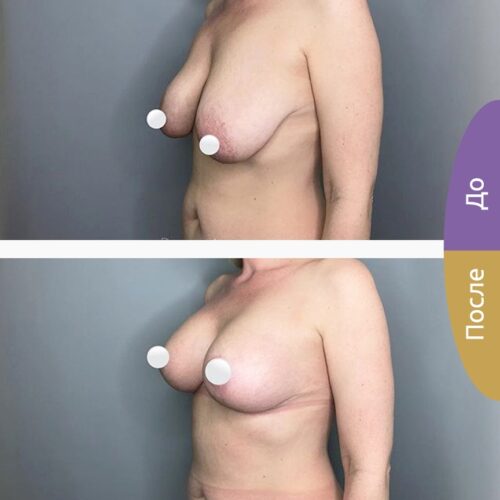 Подтяжка груди