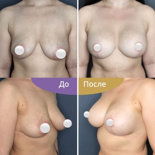 Подтяжка груди