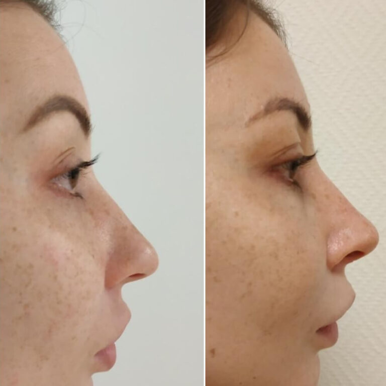 Ринопластика