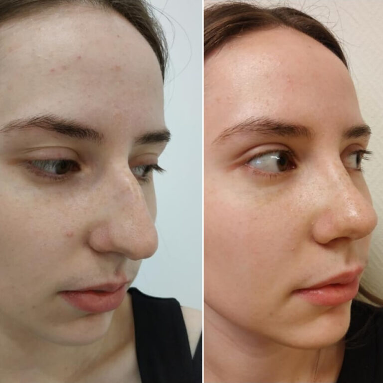 Ринопластика