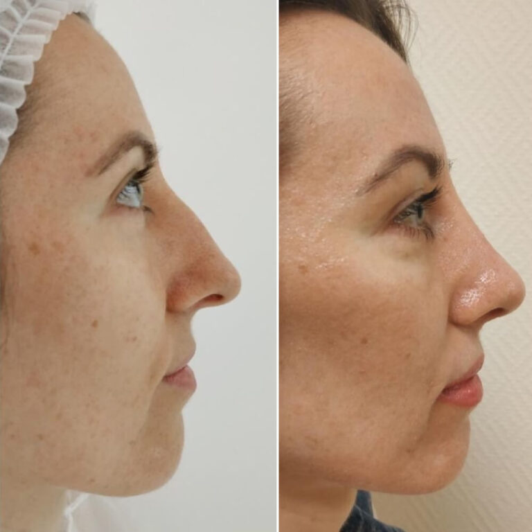 Ринопластика