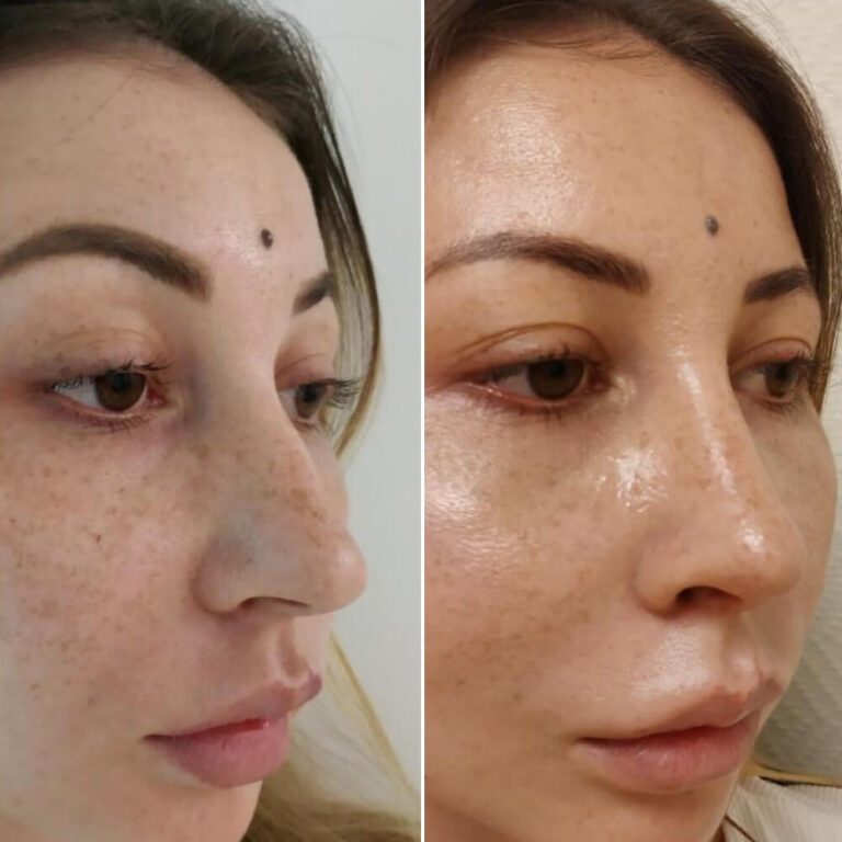 Ринопластика