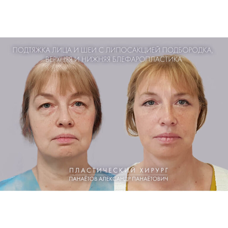 Пластика век — блефаропластика