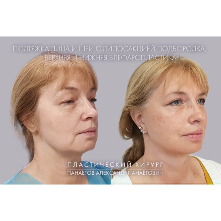 Пластика век — блефаропластика