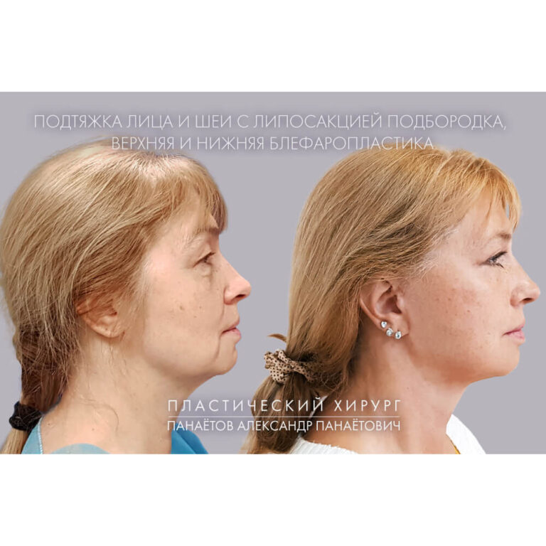 Пластика век — блефаропластика