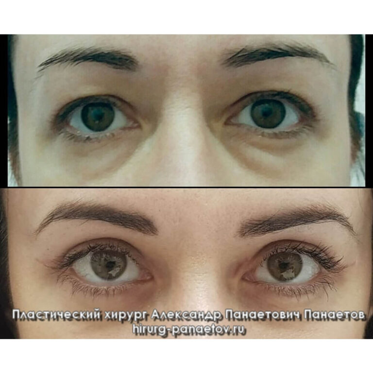 Пластика век — блефаропластика