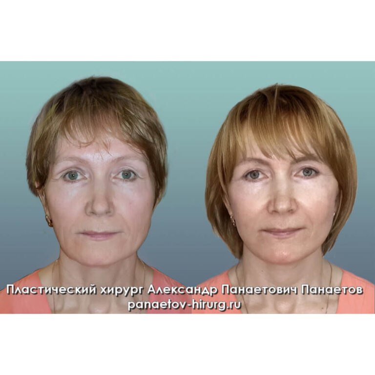 Пластика век — блефаропластика