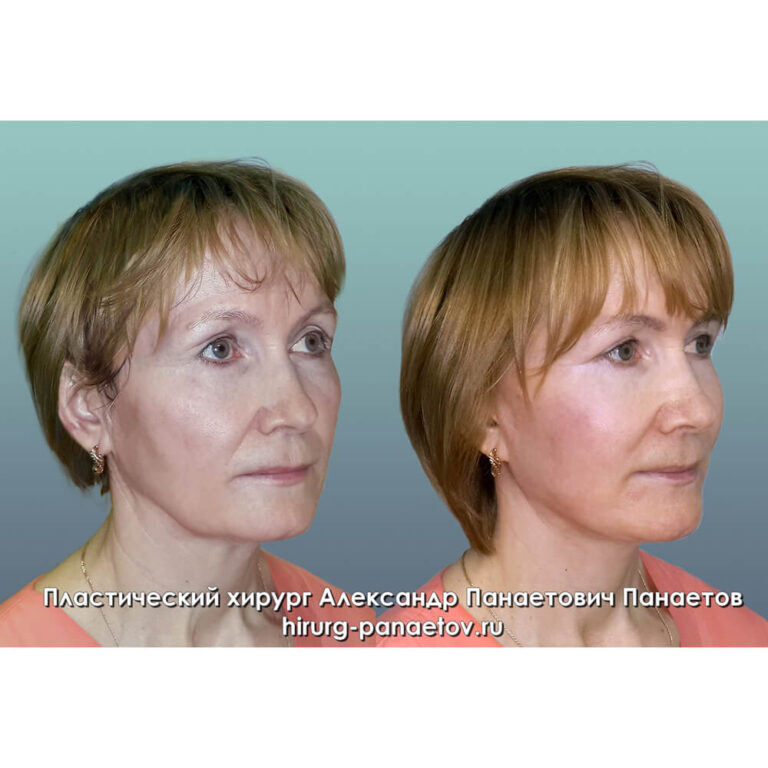 Пластика век — блефаропластика