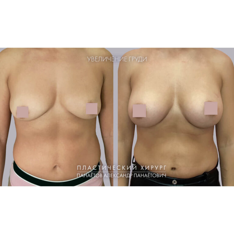 Увеличение груди