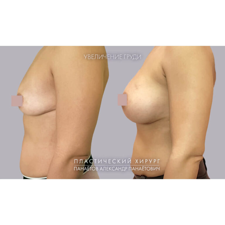Увеличение груди