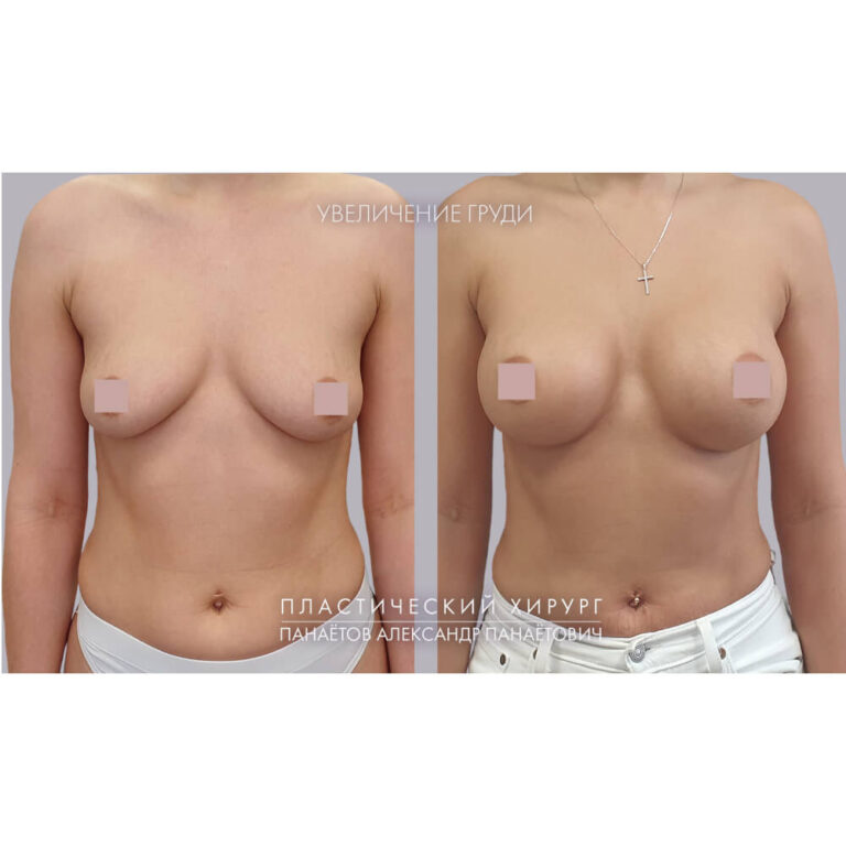 Увеличение груди