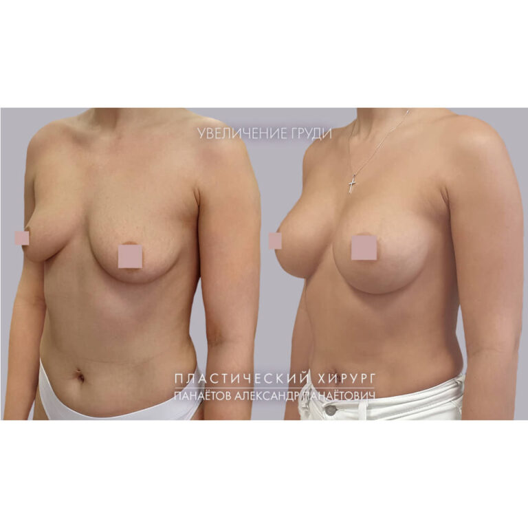 Увеличение груди