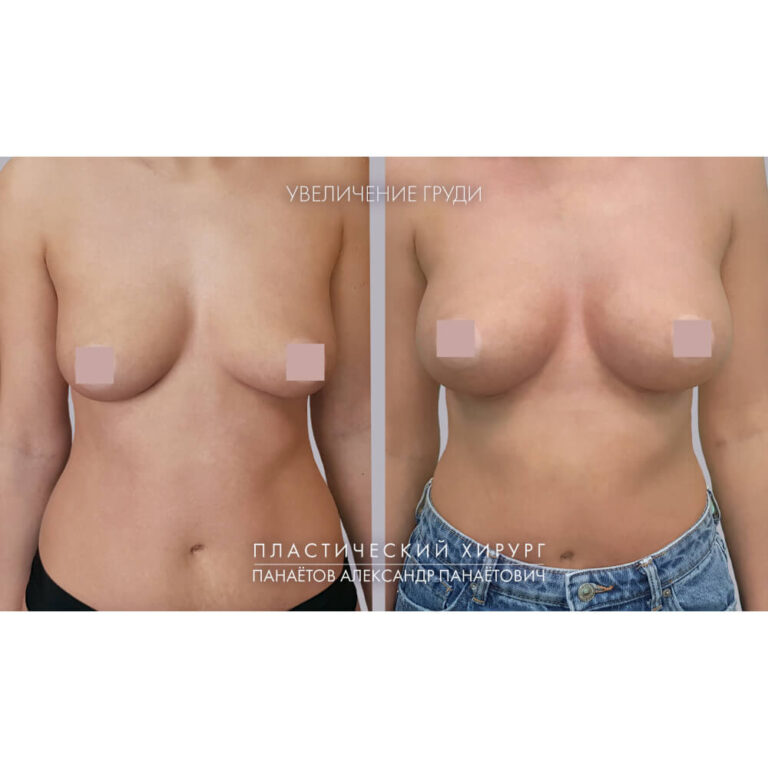 Увеличение груди