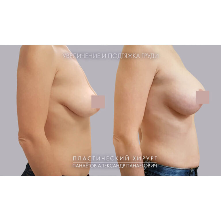 Увеличение груди