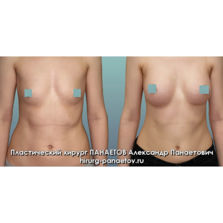 Увеличение груди