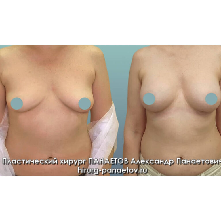 Увеличение груди