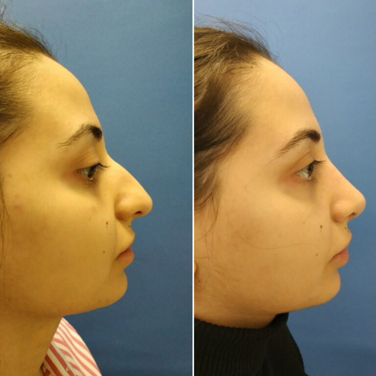 Ринопластика