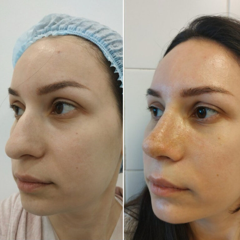 Ринопластика