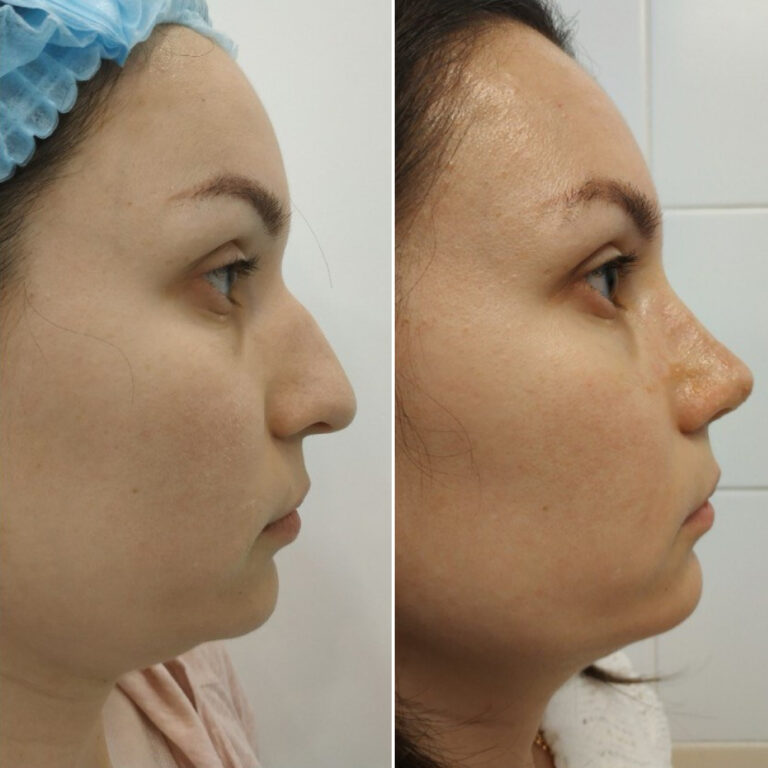 Ринопластика