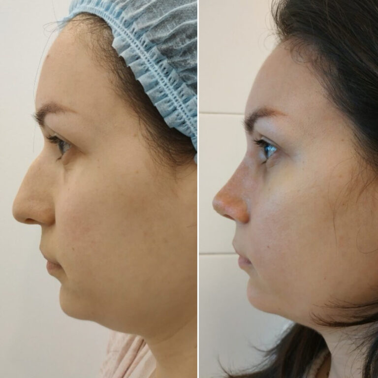 Ринопластика