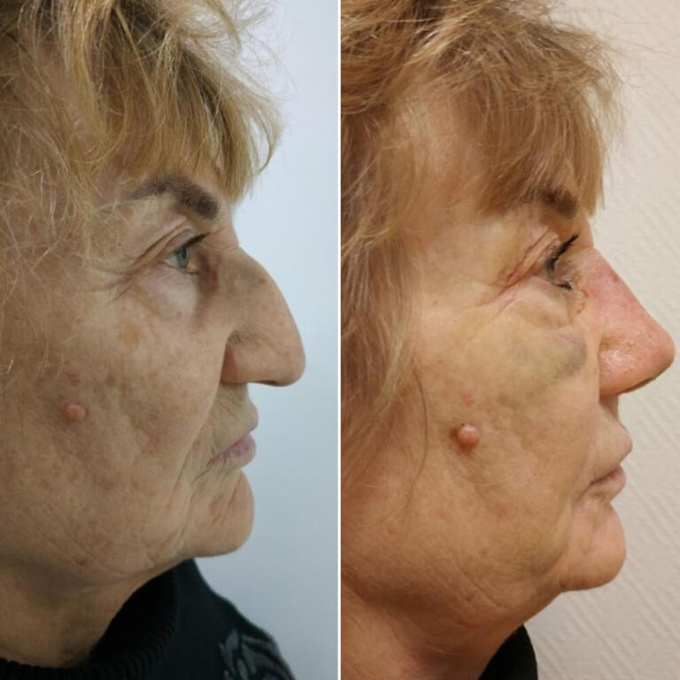 Ринопластика