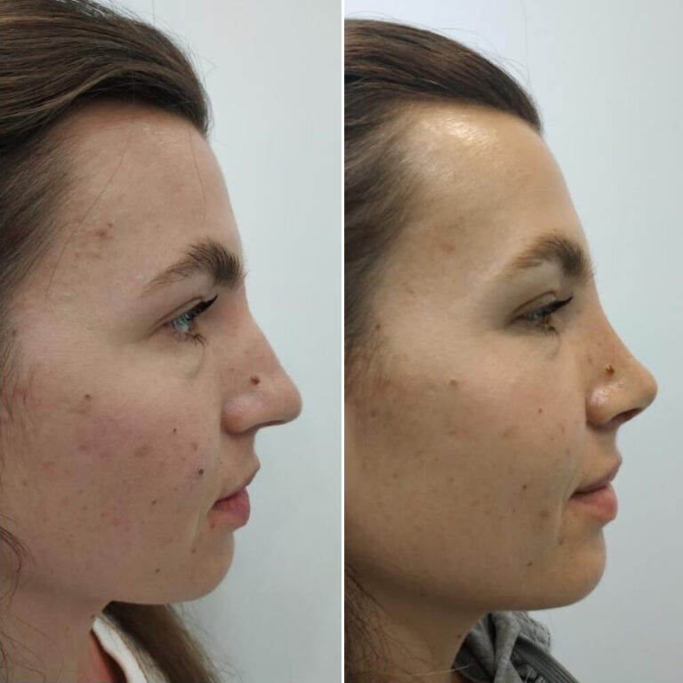 Ринопластика