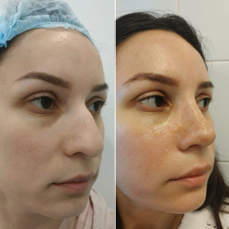 Ринопластика