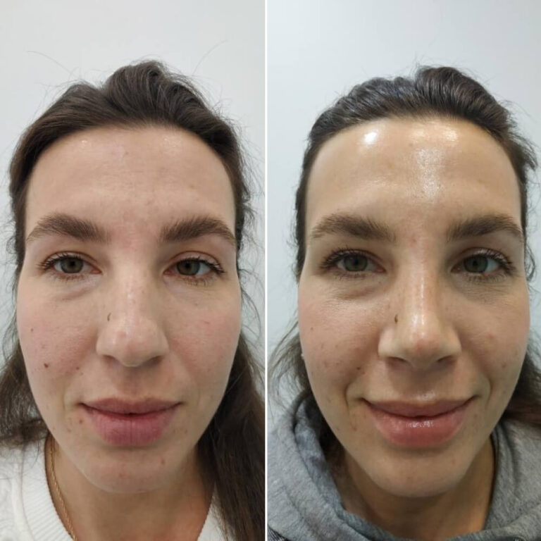 Ринопластика