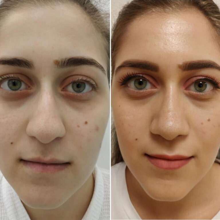 Ринопластика