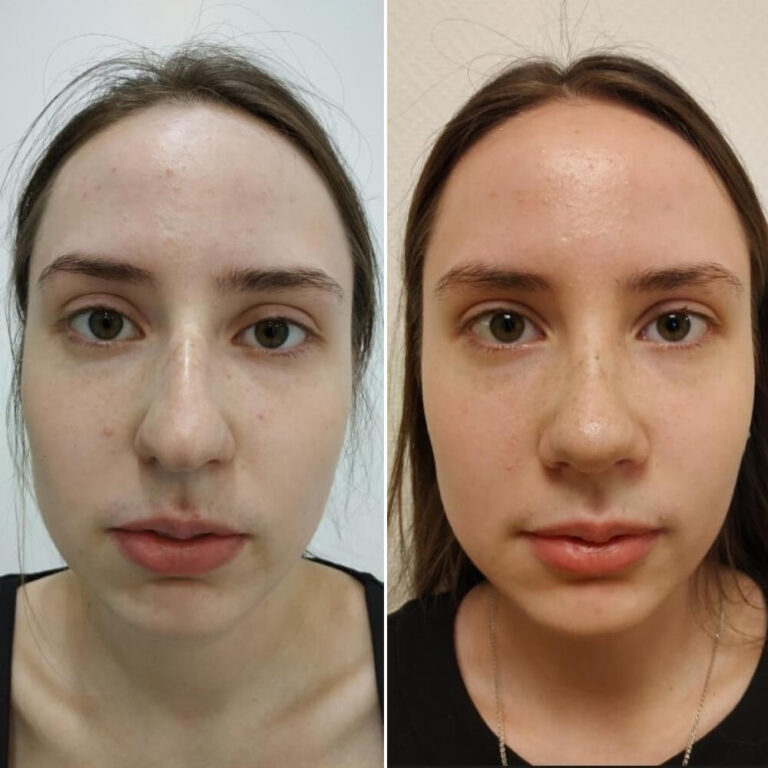 Ринопластика