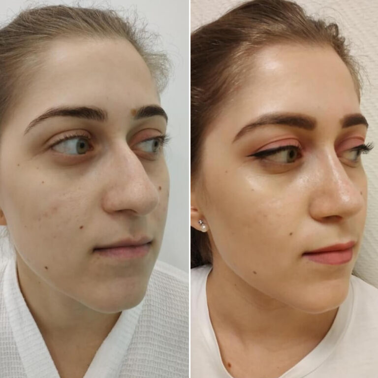 Ринопластика