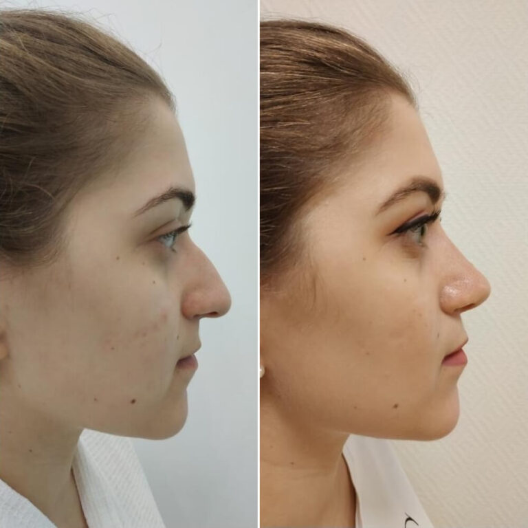 Ринопластика