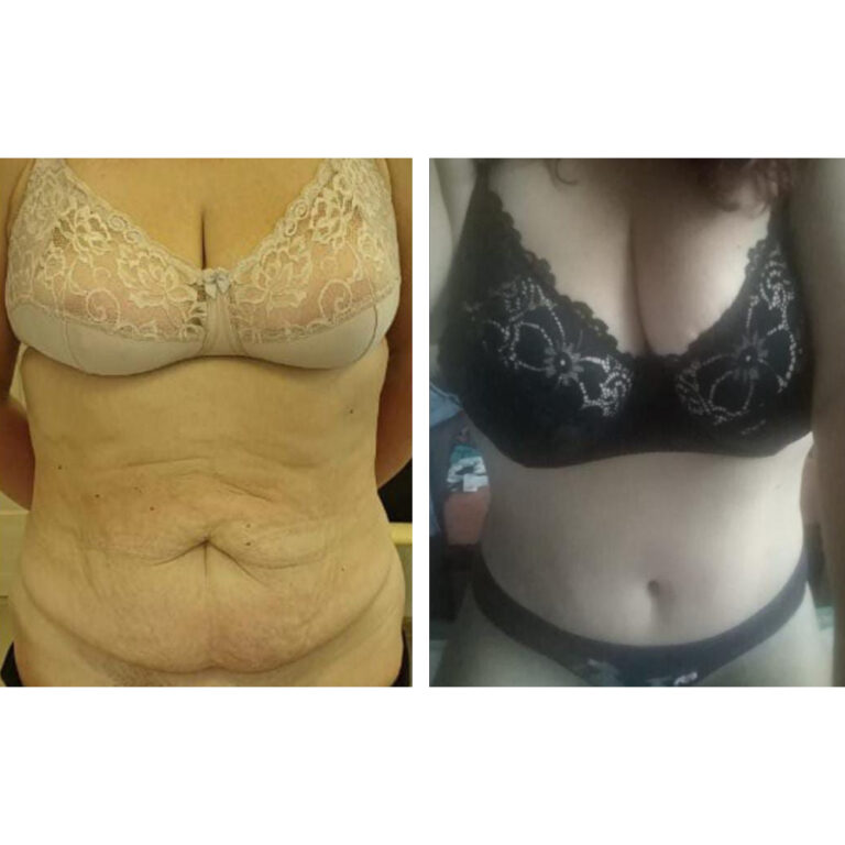 Пластика живота — Абдоминопластика