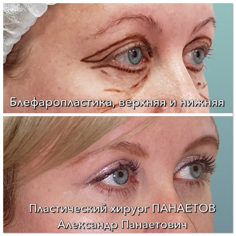 Пластика век — блефаропластика