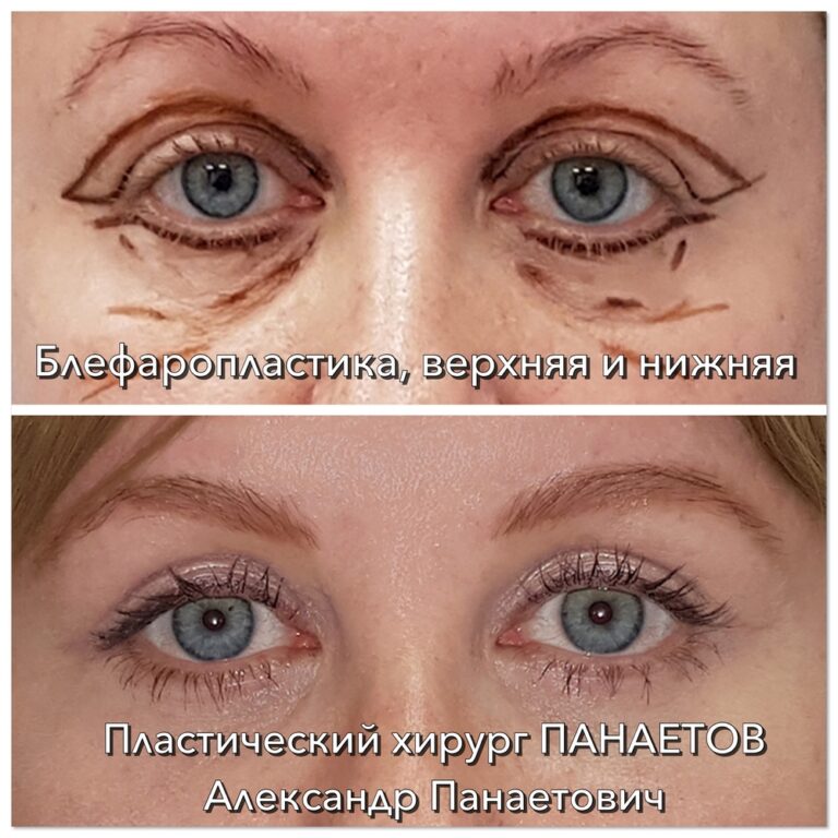 Пластика век — блефаропластика