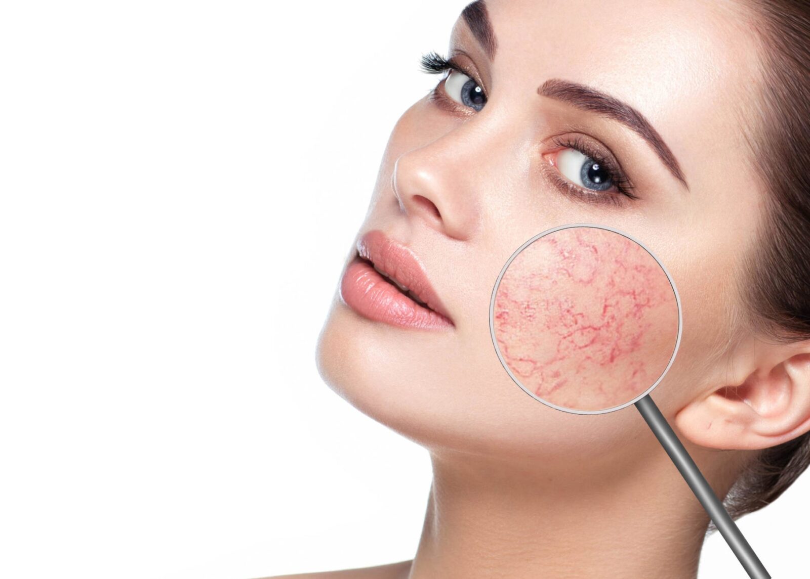 Удаление купероза лазером