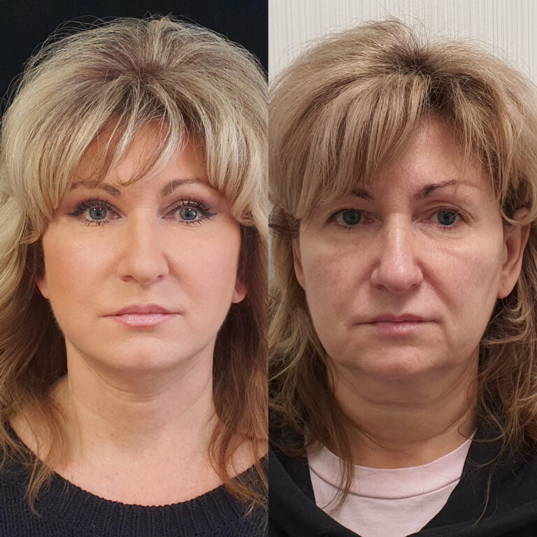 Пластика век — блефаропластика