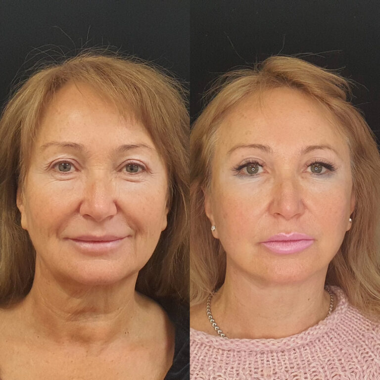 Пластика век — блефаропластика