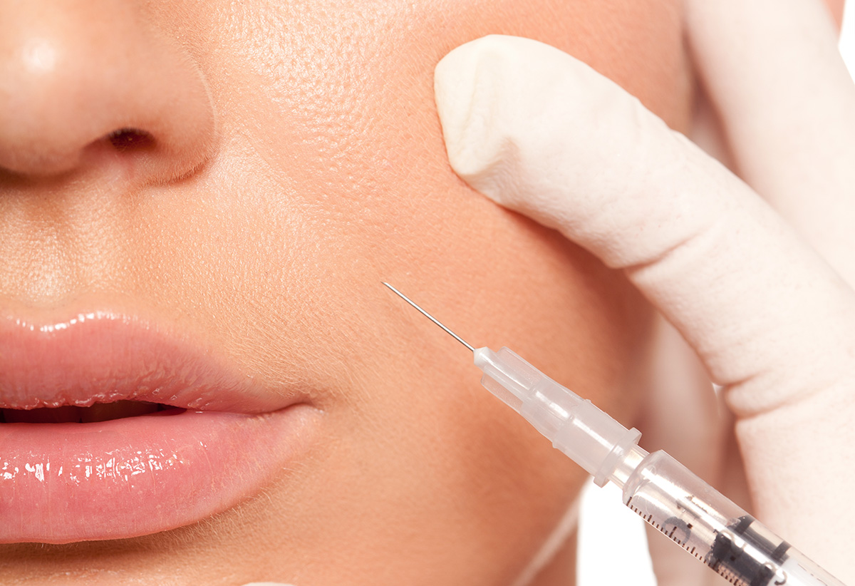 Контурная пластика носогубных складок