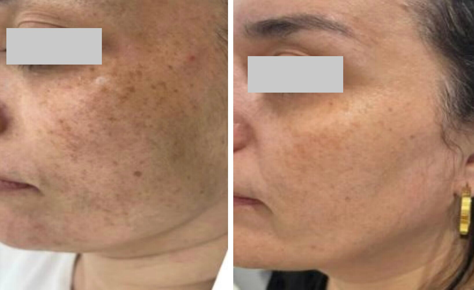 Омоложение с использованием собственных экзосом