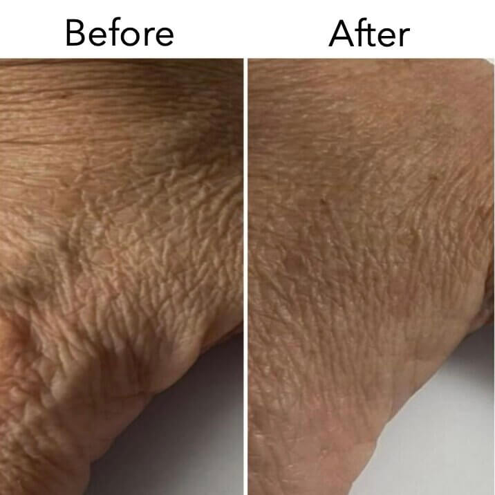 Омоложение с использованием собственных экзосом