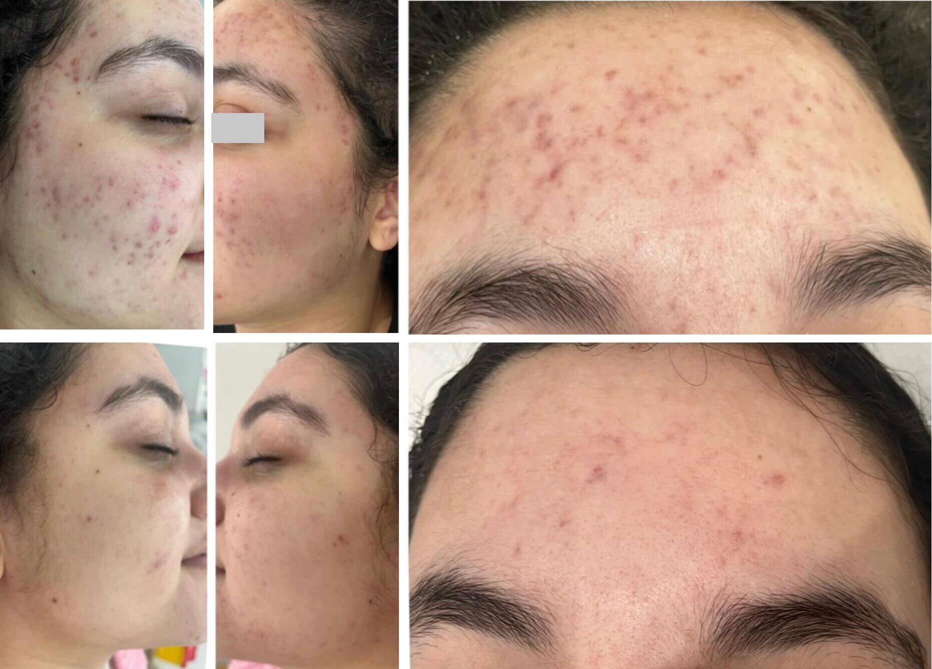 Омоложение с использованием собственных экзосом