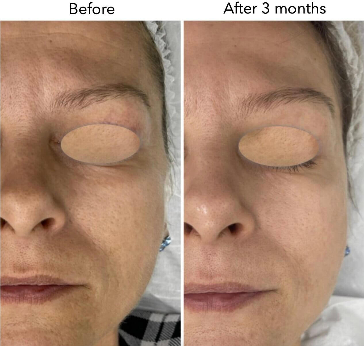 Омоложение с использованием собственных экзосом