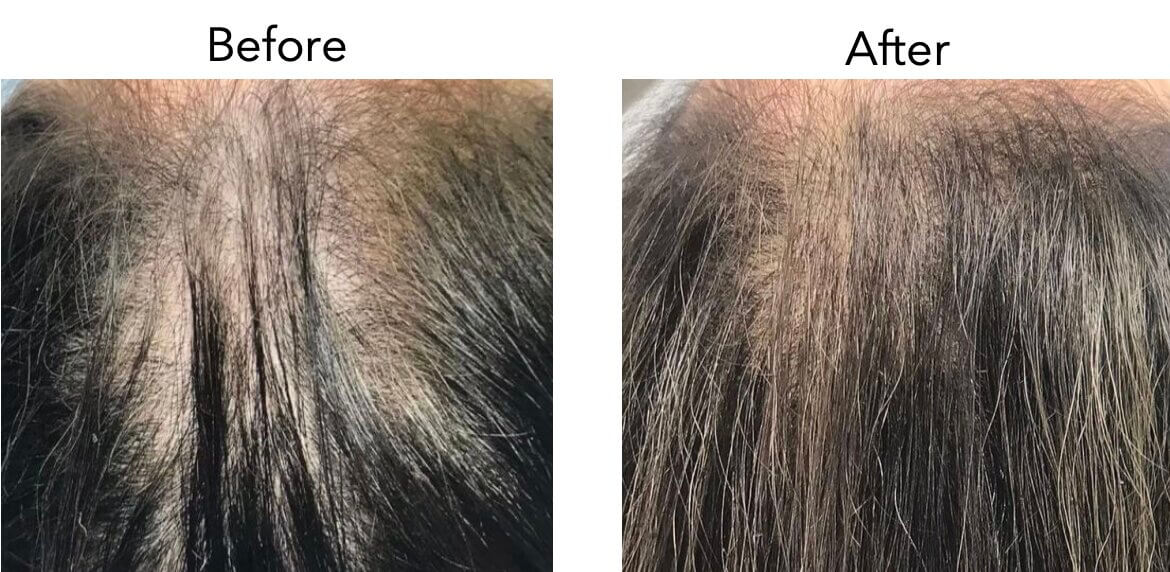 Омоложение с использованием собственных экзосом