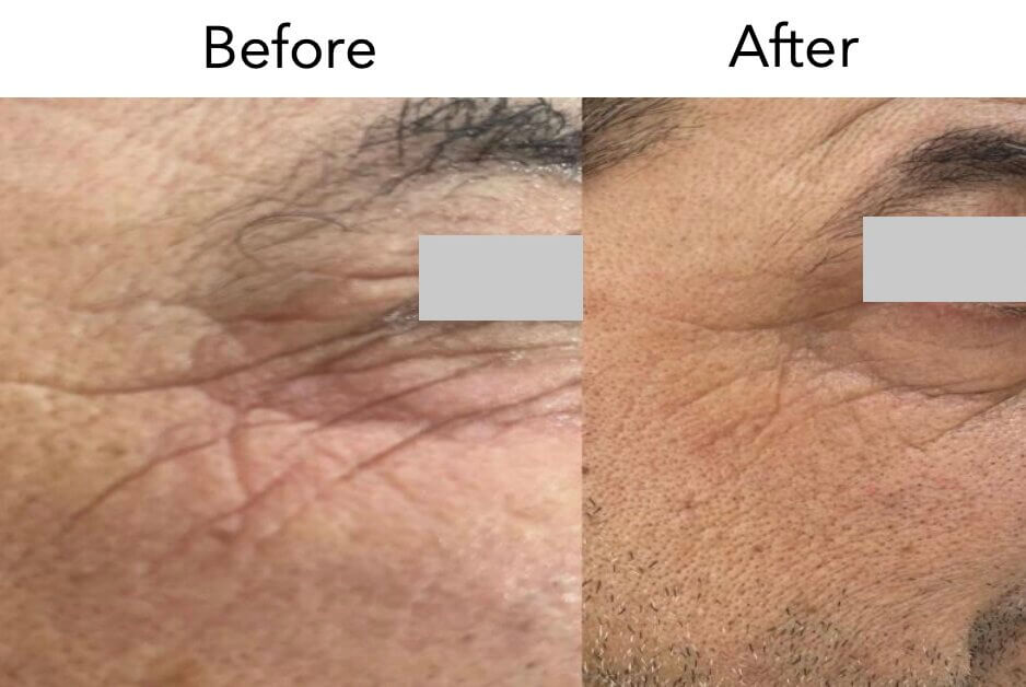 Омоложение с использованием собственных экзосом