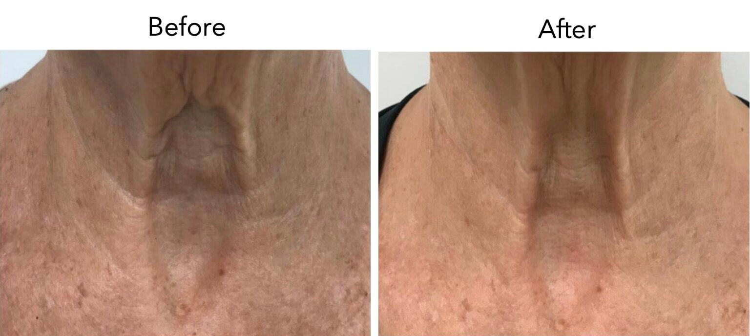 Омоложение с использованием собственных экзосом